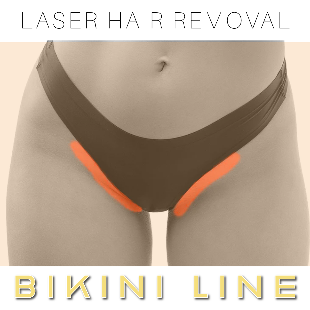 Bikini Line Laser Hair Removal Bikini line laser hair removal at a spa