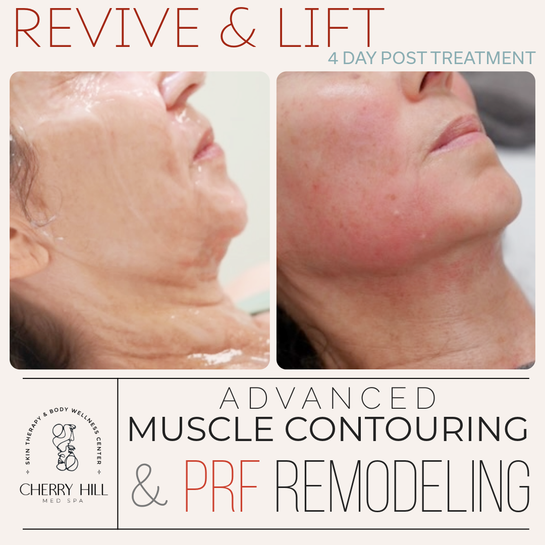 Revive & Lift – Advanced PRF Micro Needling & Muscle Contouring