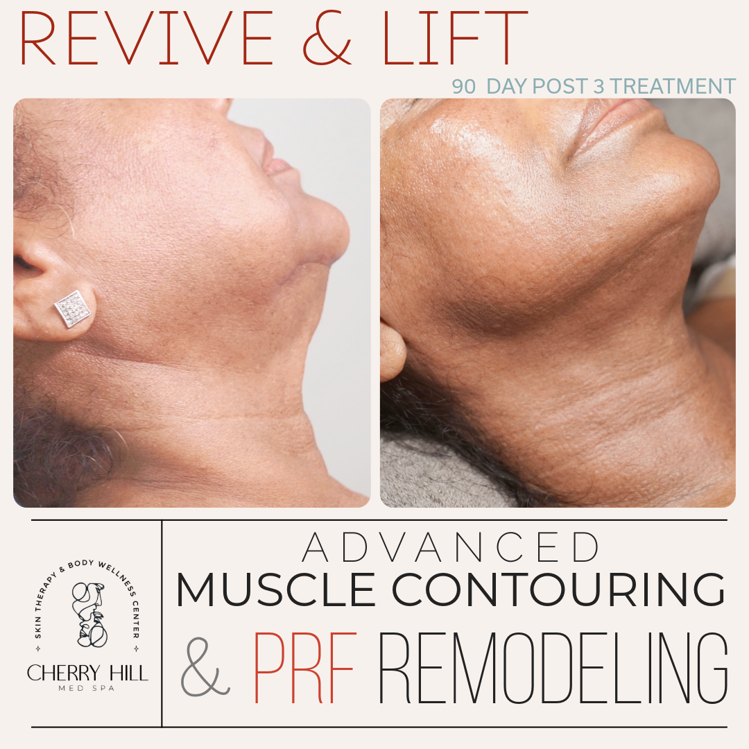 Revive & Lift – Advanced PRF Micro Needling & Muscle Contouring