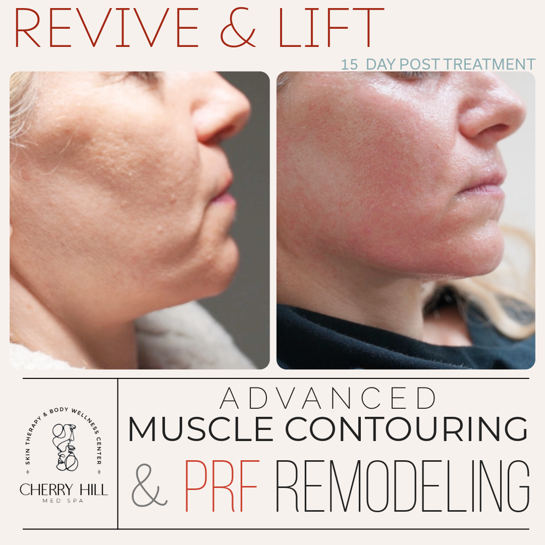 Revive & Lift – Advanced PRF Micro Needling & Muscle Contouring