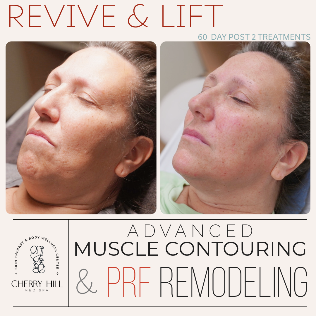 Revive & Lift – Advanced PRF Micro Needling & Muscle Contouring
