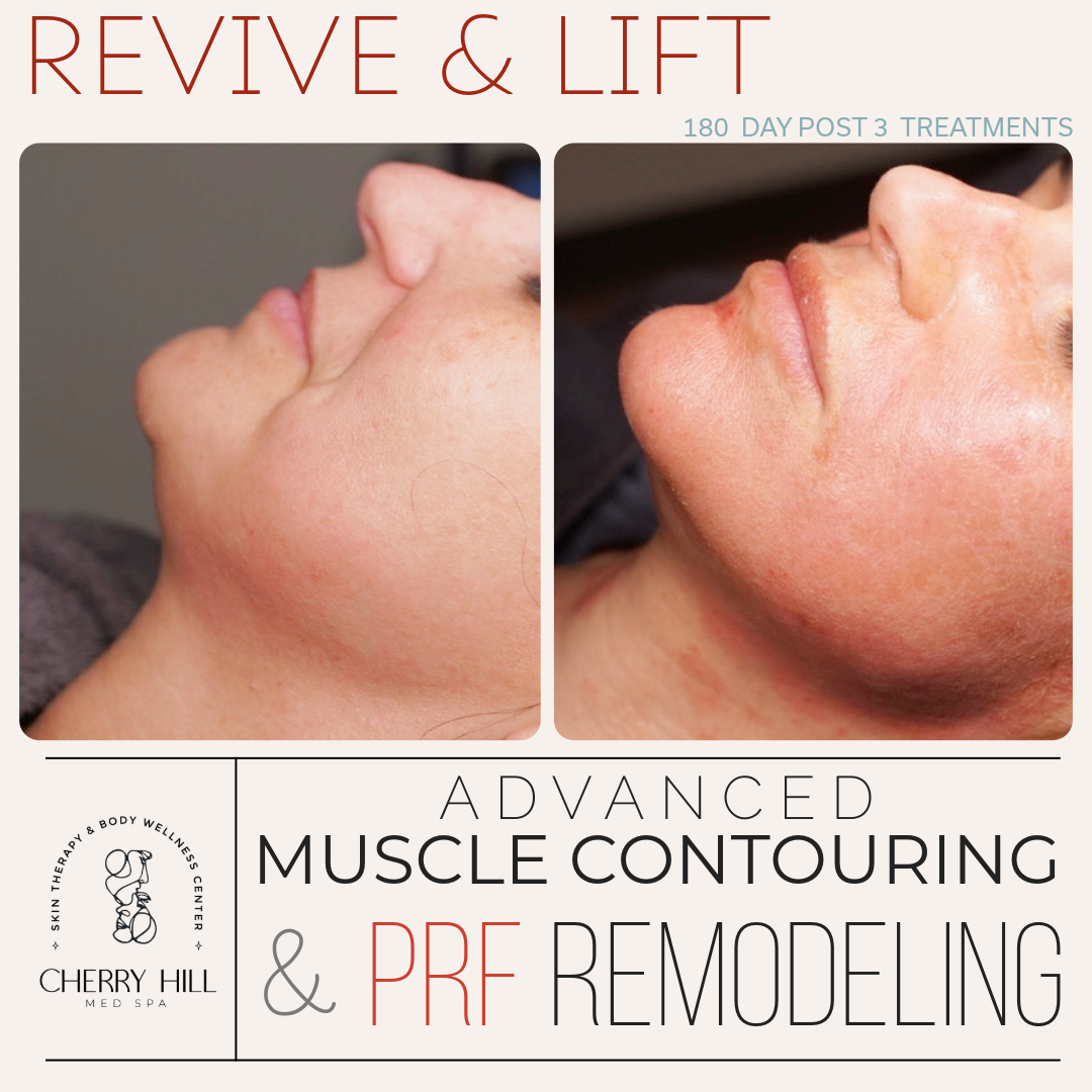 Revive & Lift – Advanced PRF Micro Needling & Muscle Contouring