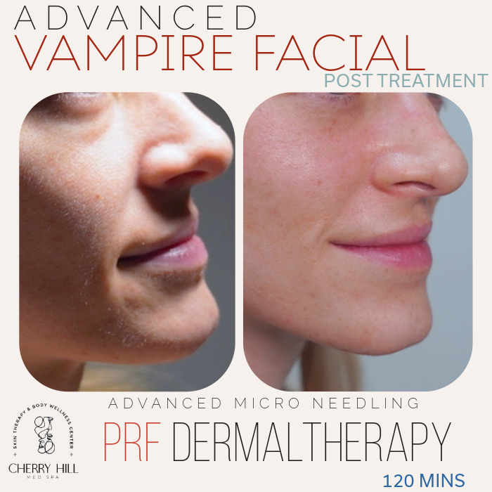 VAMPIRE FACIAL - Advanced PRF Dermal Therapy