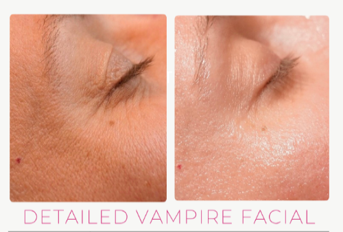 VAMPIRE FACIAL (MICRO NEEDLING WITH PRF)