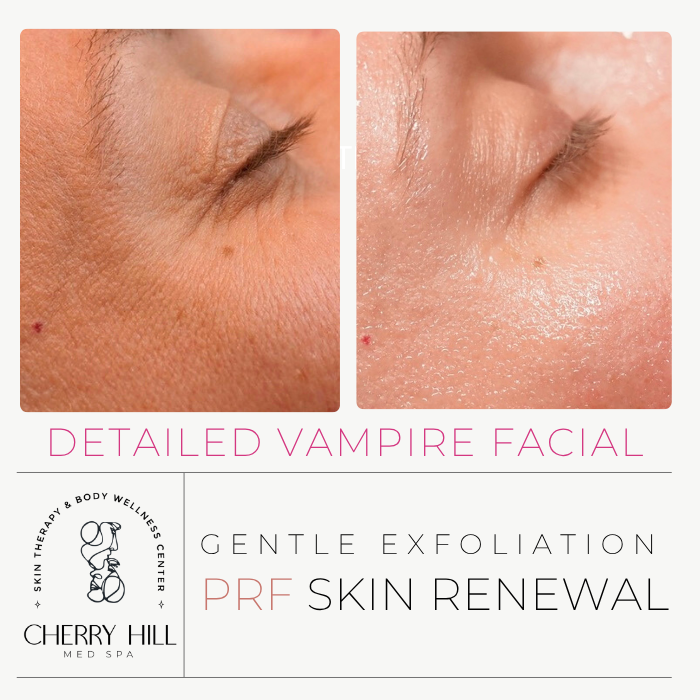 VAMPIRE FACIAL (MICRO NEEDLING WITH PRF)