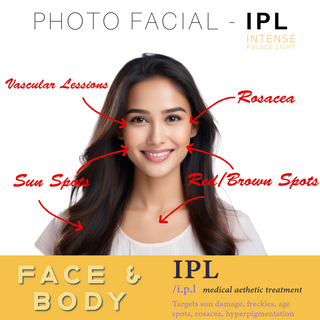 IPL - Intense Pulsed Light Single Treatment