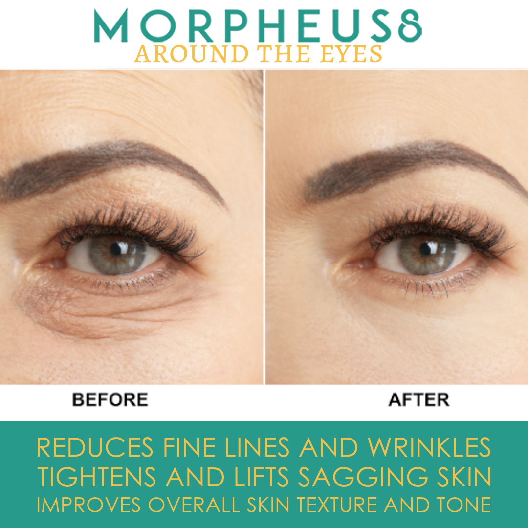 Around the Eye Morpheus8 3 Treatment Package