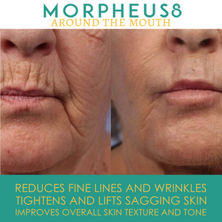 Around the Mouth Morpheus8 Treatment