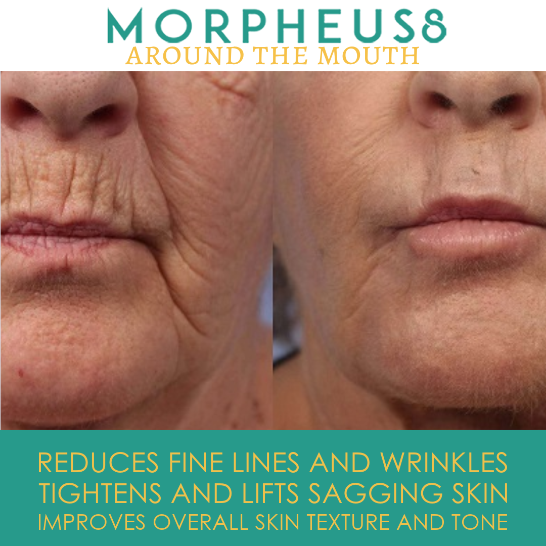 Around the Mouth Morpheus8 Treatment