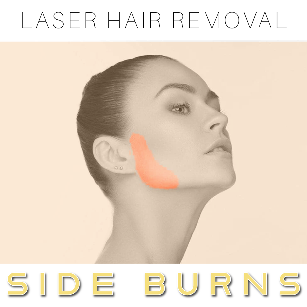 Side Burns - Laser Hair Removal