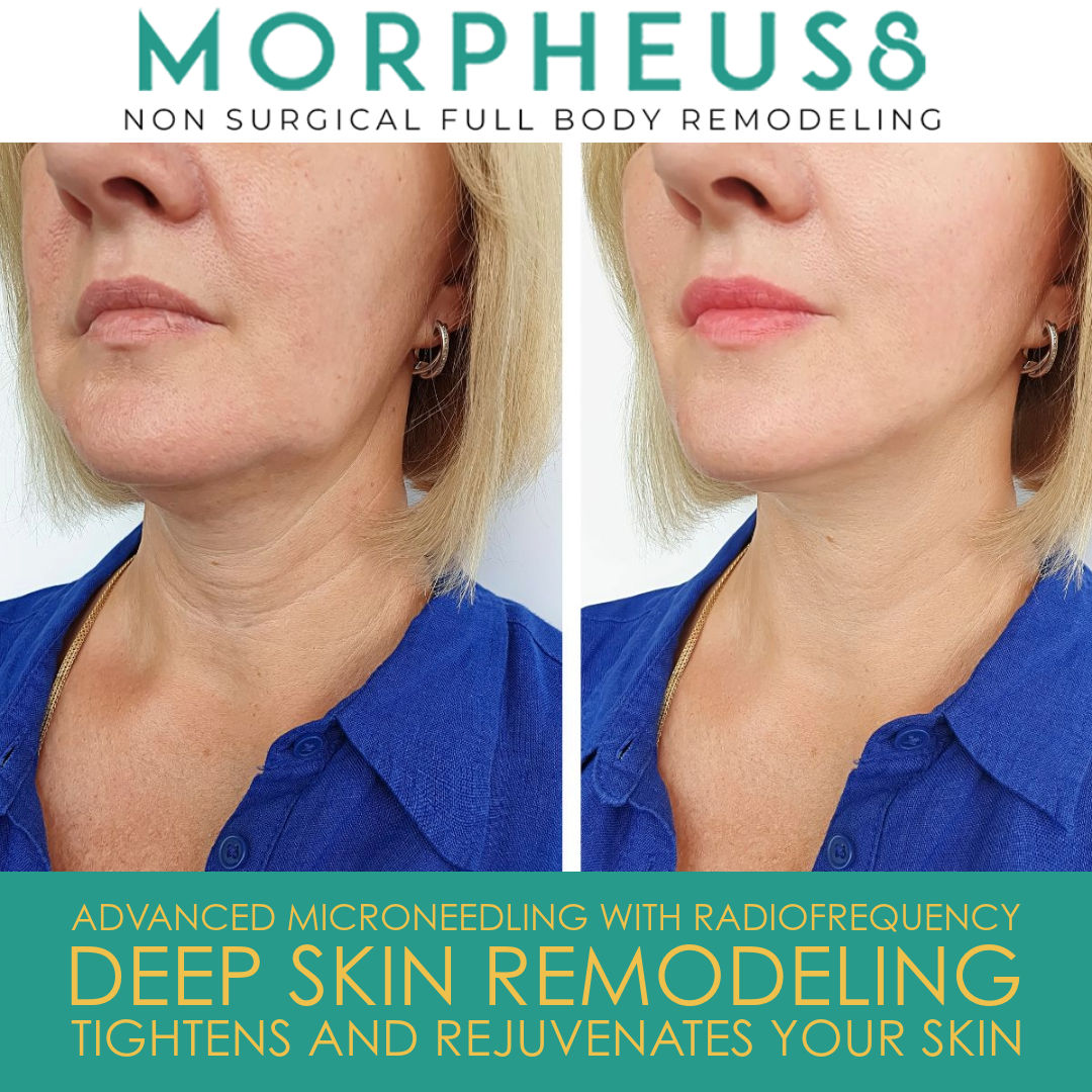 Morpheus8 RF Microneedling