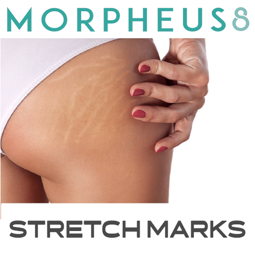 Morpheus8 Stretch Marks Treatment Package