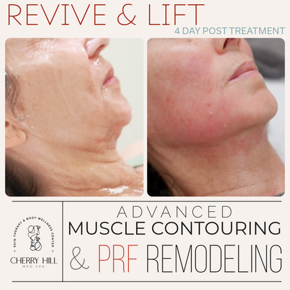 Revive &amp; Lift –  Advanced PRF Micro Needling &amp; Muscle Contouring