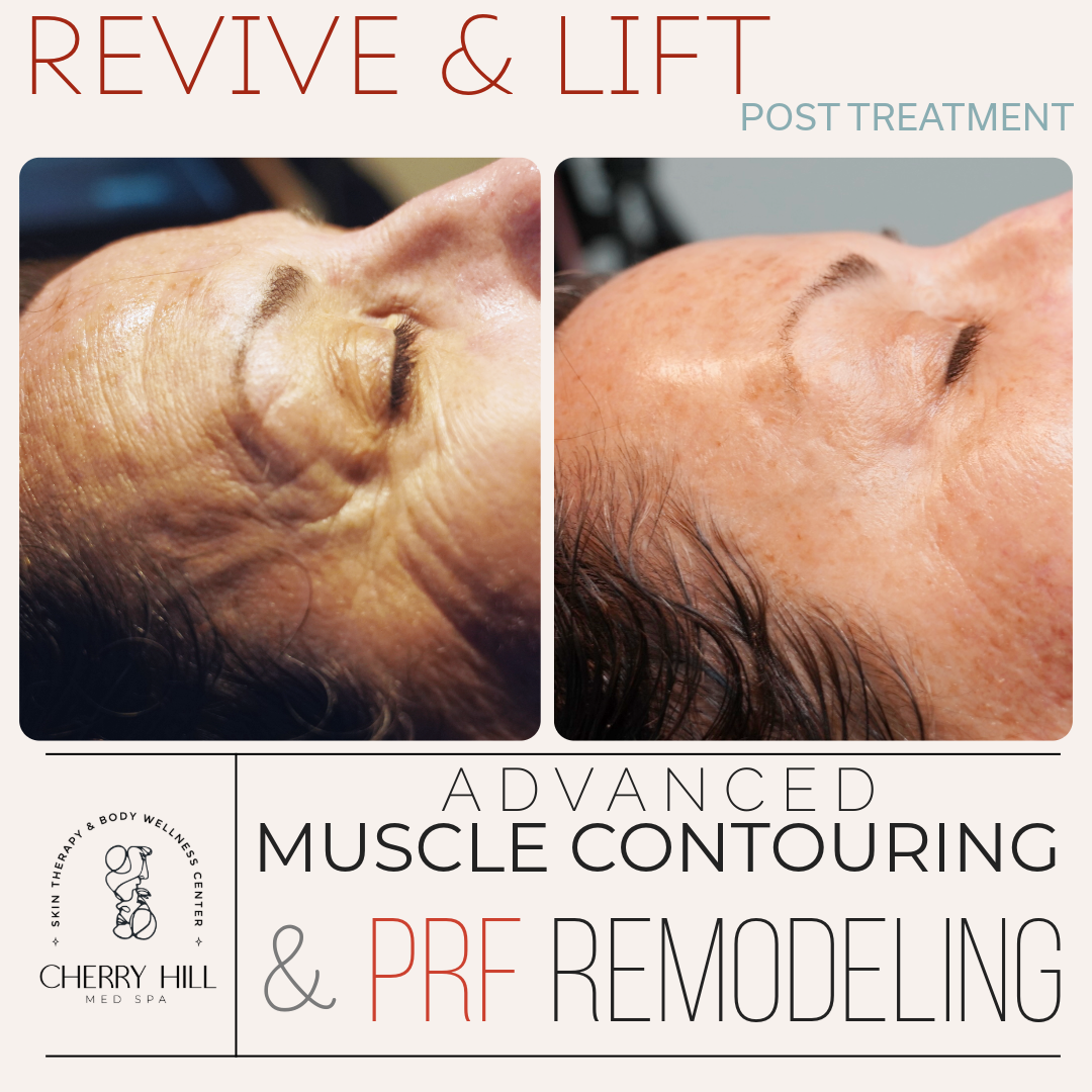 Revive &amp; Lift –  Advanced PRF Micro Needling &amp; Muscle Contouring