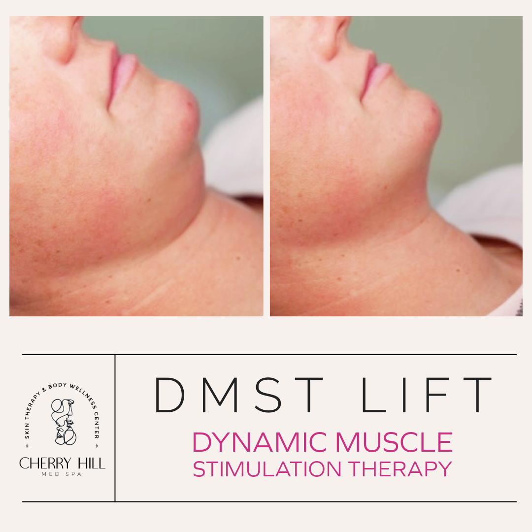 DMST Lift - Dynamic Muscle Contouring 60 Min Session