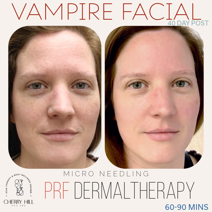 VAMPIRE FACIAL (MICRO NEEDLING WITH PRF)