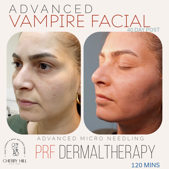 VAMPIRE FACIAL - Advanced PRF Dermal Therapy